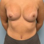 Breast Augmentation Before & After Patient #12127