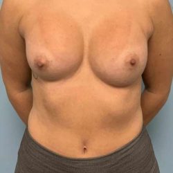 Breast Augmentation Before & After Patient #12127
