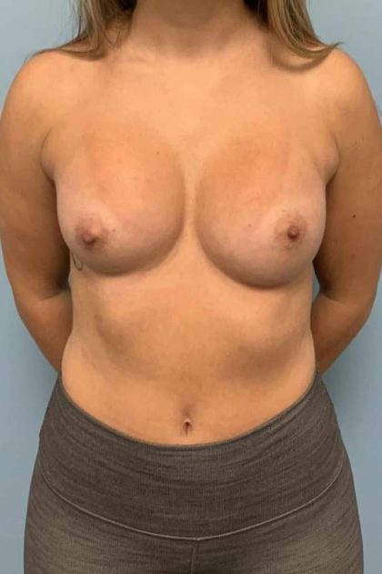 Breast Augmentation Before & After Patient #12127