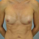 Breast Augmentation Before & After Patient #12143