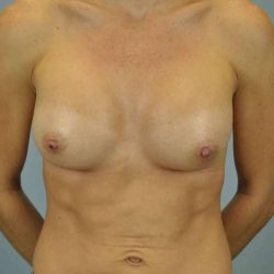 Breast Augmentation Before & After Patient #12143