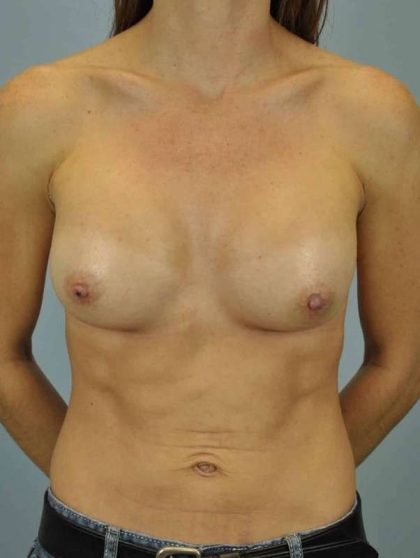 Breast Augmentation Before & After Patient #12143