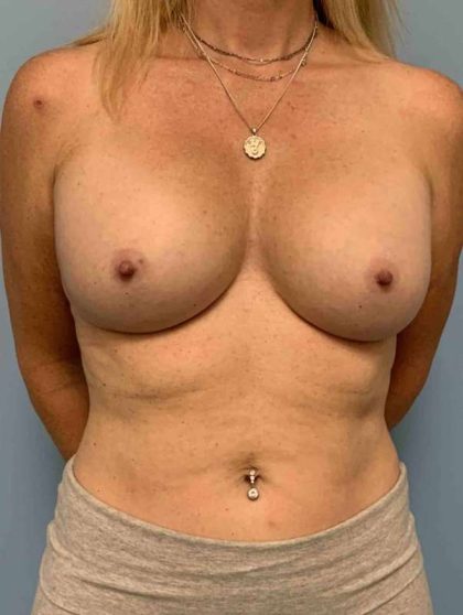 Breast Augmentation Before & After Patient #12150