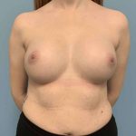 Breast Augmentation Before & After Patient #12157