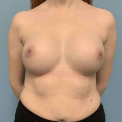 Breast Augmentation Before & After Patient #12157
