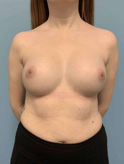 Breast Augmentation Before & After Patient #12157