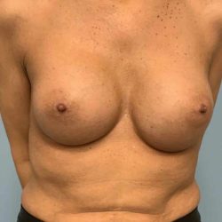 Breast Augmentation Before & After Patient #12171