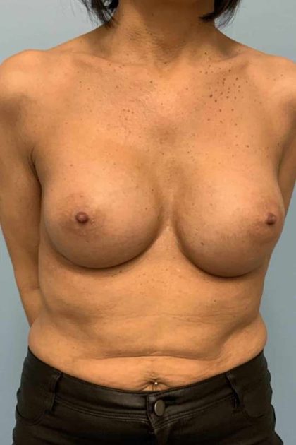 Breast Augmentation Before & After Patient #12171