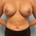 Breast Augmentation Before & After Patient #12178