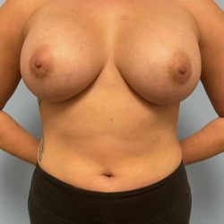 Breast Augmentation Before & After Patient #12178