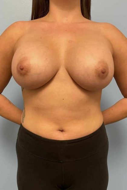 Breast Augmentation Before & After Patient #12178