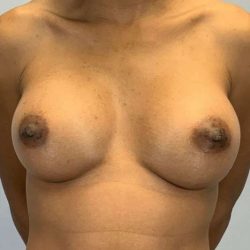 Breast Augmentation Before & After Patient #12199