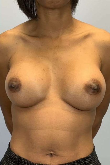 Breast Augmentation Before & After Patient #12199
