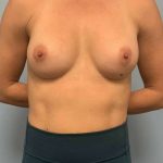 Breast Augmentation Before & After Patient #12206