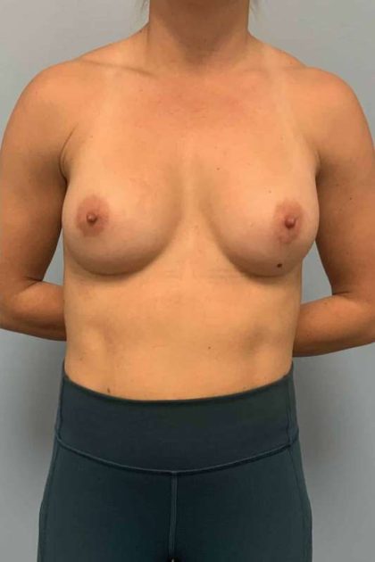 Breast Augmentation Before & After Patient #12206