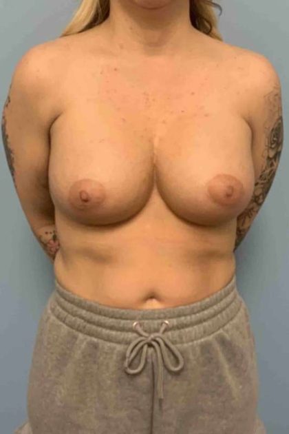 Breast Augmentation Before & After Patient #12227