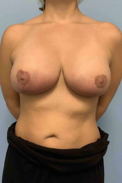 Breast Augmentation Before & After Patient #12234