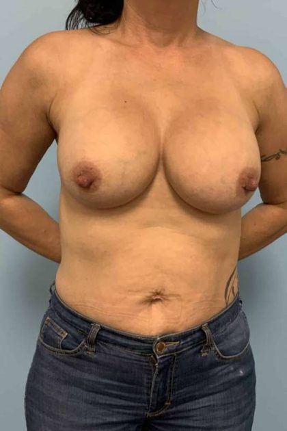 Breast Augmentation Before & After Patient #12246