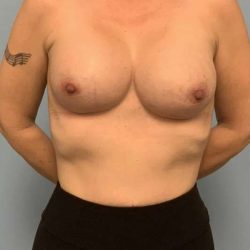 Breast Augmentation Before & After Patient #12295