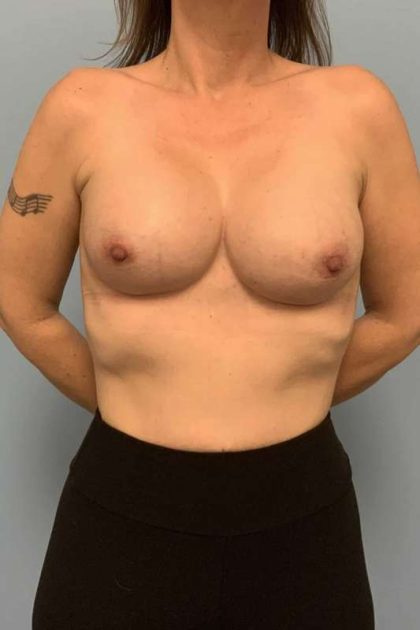 Breast Augmentation Before & After Patient #12295