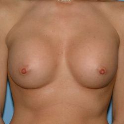 Breast Augmentation Before & After Patient #12316