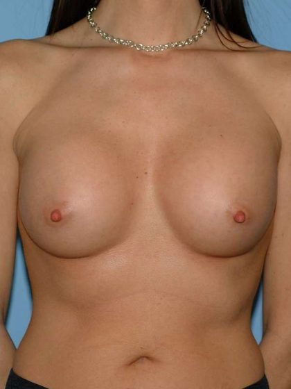 Breast Augmentation Before & After Patient #12316
