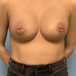 Breast Augmentation Before & After Patient #12323
