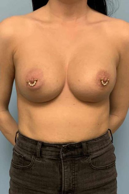 Breast Augmentation Before & After Patient #12323