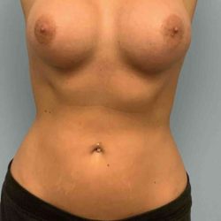 Breast Augmentation Before & After Patient #12330