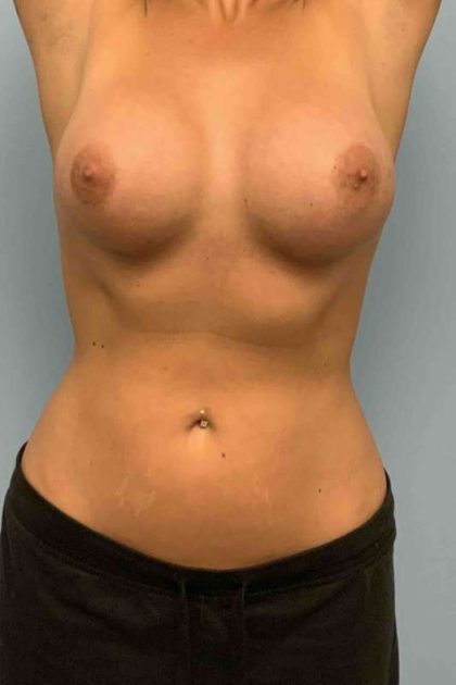 Breast Augmentation Before & After Patient #12330
