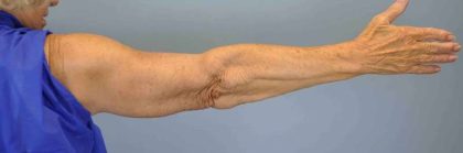 Brachioplasty Before & After Patient #12348