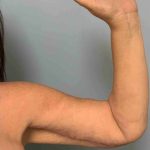 Brachioplasty Before & After Patient #12362