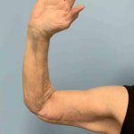 Brachioplasty Before & After Patient #12371
