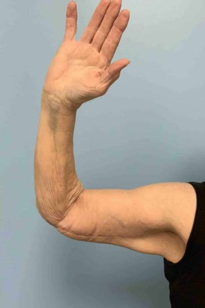 Brachioplasty Before & After Patient #12371