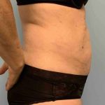 VASER Liposelection Before & After Patient #10446