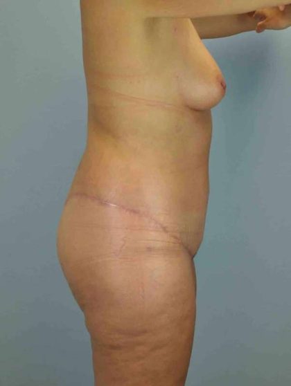 VASER Liposelection Before & After Patient #10457