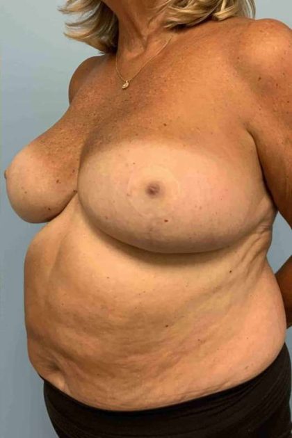 VASER Liposelection Before & After Patient #10466