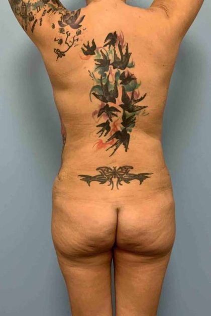 VASER Liposelection Before & After Patient #10479