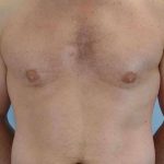 VASER Liposelection Before & After Patient #10486