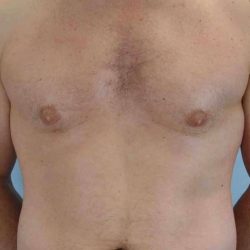 VASER Liposelection Before & After Patient #10486