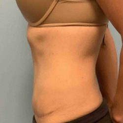 VASER Liposelection Before & After Patient #10493