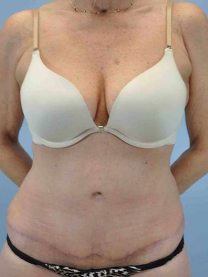 VASER Liposelection Before & After Patient #10511