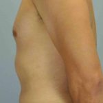VASER Liposelection Before & After Patient #10527