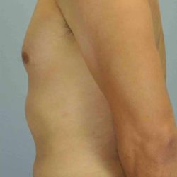 VASER Liposelection Before & After Patient #10527