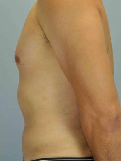 VASER Liposelection Before & After Patient #10527