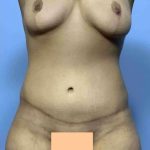VASER Liposelection Before & After Patient #10534