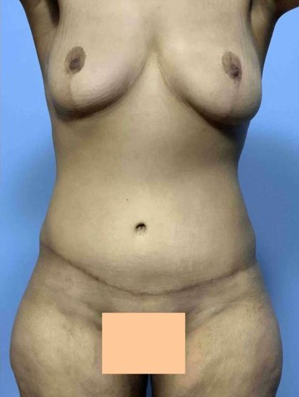 VASER Liposelection Before & After Patient #10534