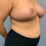 VASER Liposelection Before & After Patient #10552