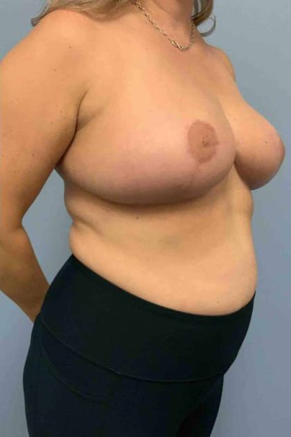 VASER Liposelection Before & After Patient #10552