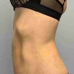 VASER Liposelection Before & After Patient #10407